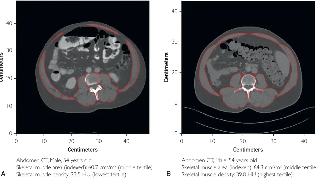 AI analyzing abdominal CT scan for muscle density