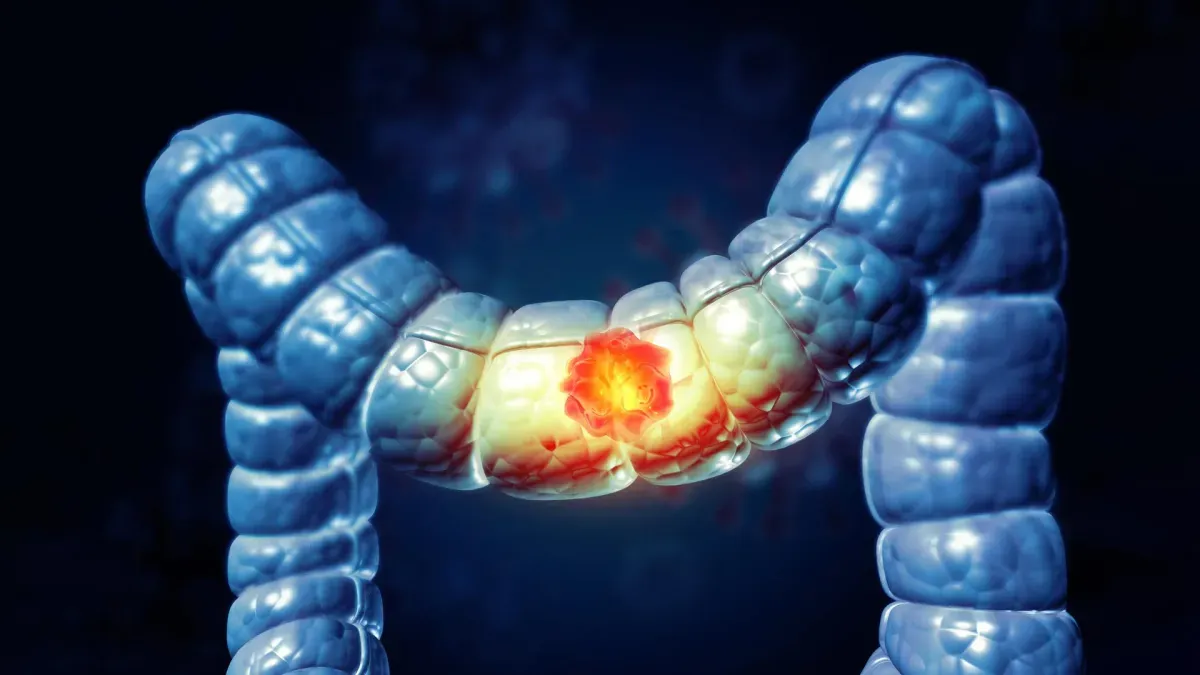 Microscopic view of stiffened colon tissue in early-onset CRC