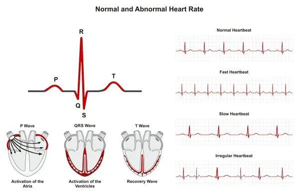 Racing Heart or Skipped Beat? Understanding Arrhythmia Causes and Treatments